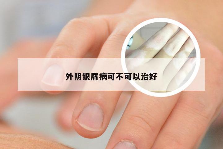 外阴银屑病可不可以治好