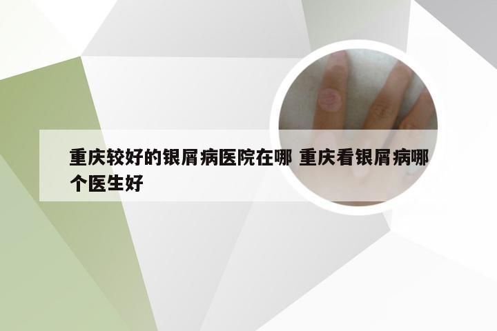 重庆较好的银屑病医院在哪 重庆看银屑病哪个医生好