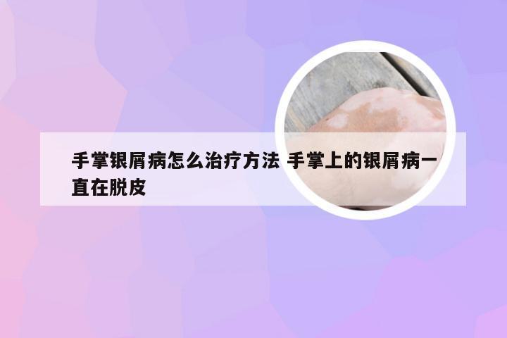 手掌银屑病怎么治疗方法 手掌上的银屑病一直在脱皮