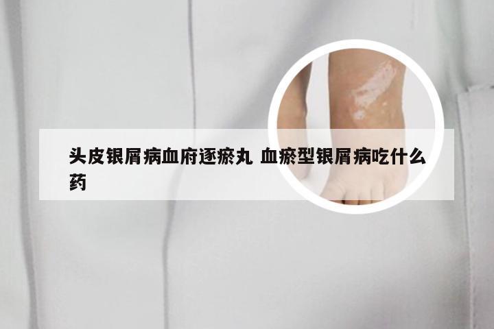 头皮银屑病血府逐瘀丸 血瘀型银屑病吃什么药