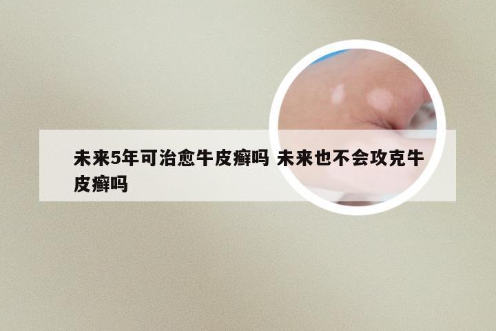 未来5年可治愈牛皮癣吗 未来也不会攻克牛皮癣吗