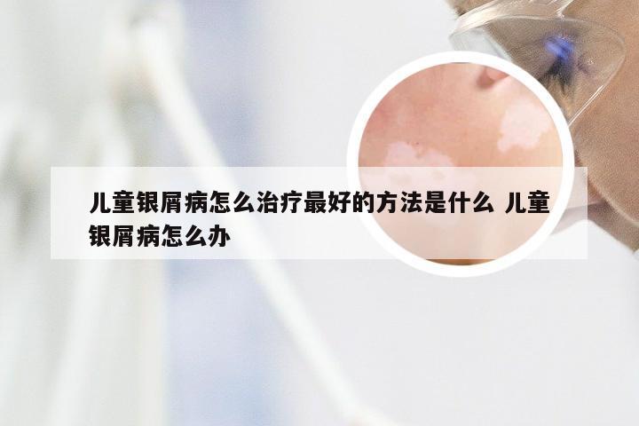 儿童银屑病怎么治疗最好的方法是什么 儿童银屑病怎么办