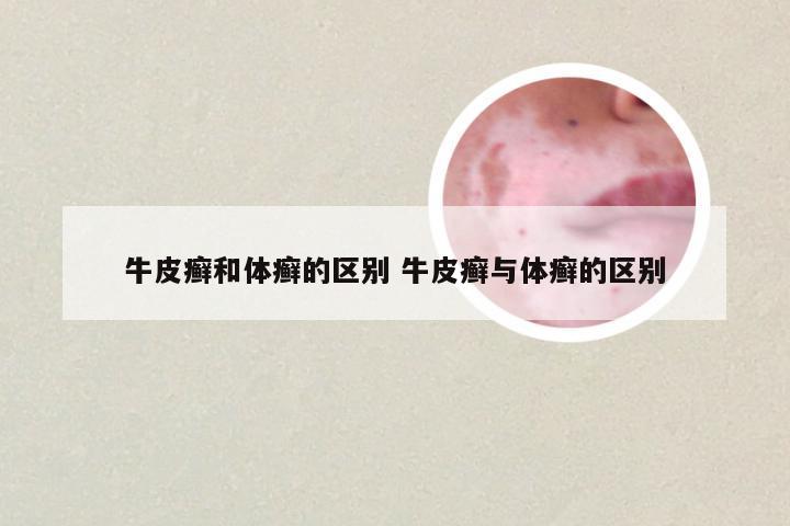 牛皮癣和体癣的区别 牛皮癣与体癣的区别