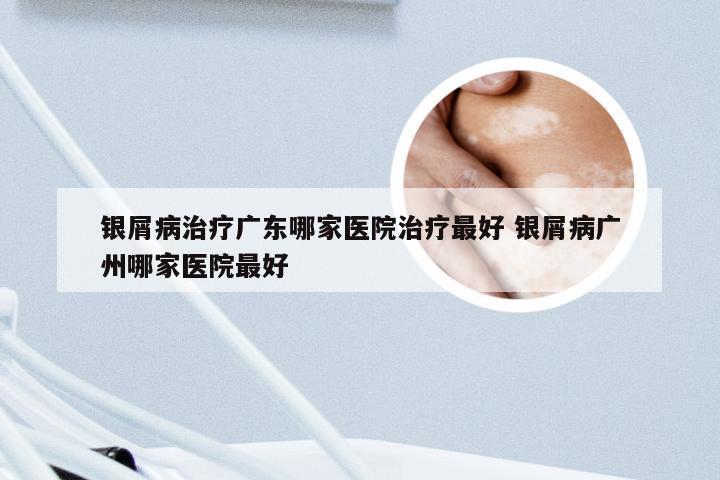 银屑病治疗广东哪家医院治疗最好 银屑病广州哪家医院最好