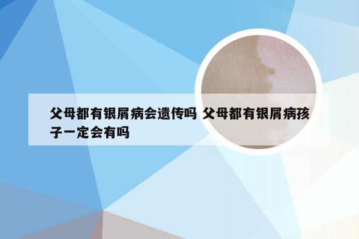 父母都有银屑病会遗传吗 父母都有银屑病孩子一定会有吗