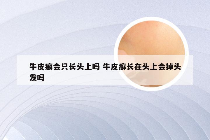 牛皮癣会只长头上吗 牛皮癣长在头上会掉头发吗