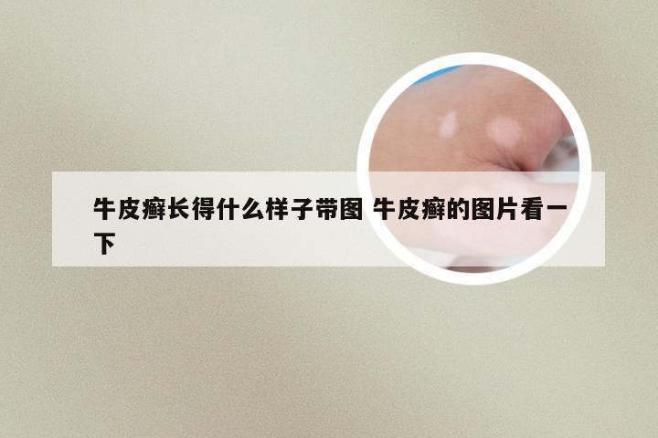 牛皮癣长得什么样子带图 牛皮癣的图片看一下