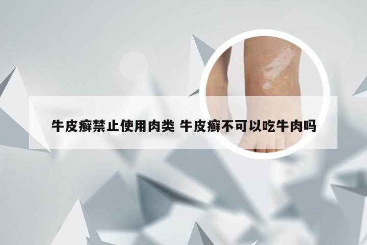 牛皮癣禁止使用肉类 牛皮癣不可以吃牛肉吗