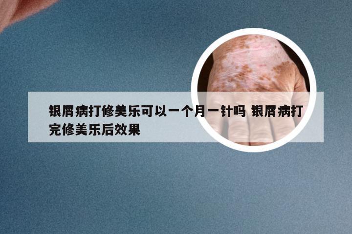 银屑病打修美乐可以一个月一针吗 银屑病打完修美乐后效果