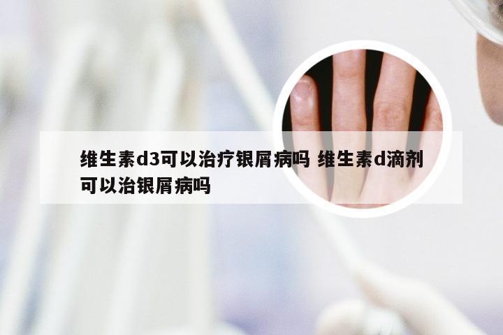 维生素d3可以治疗银屑病吗 维生素d滴剂可以治银屑病吗