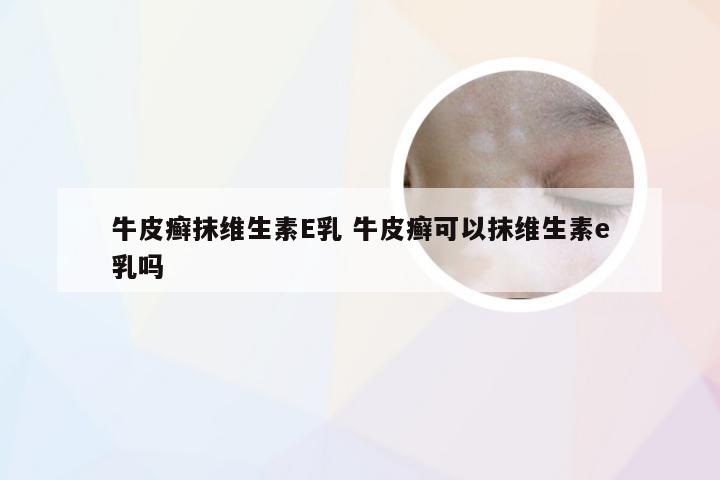 牛皮癣抹维生素E乳 牛皮癣可以抹维生素e乳吗