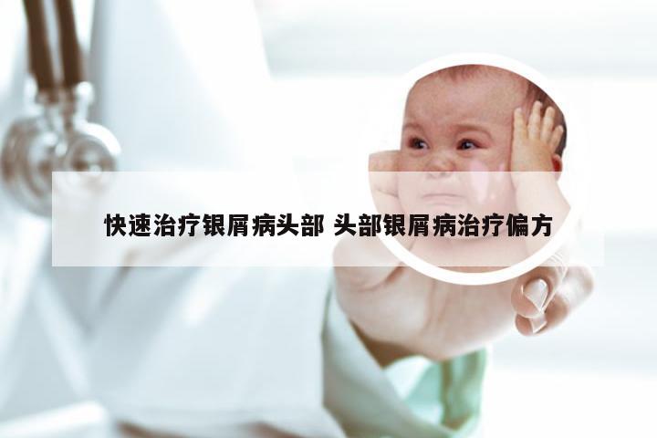 快速治疗银屑病头部 头部银屑病治疗偏方