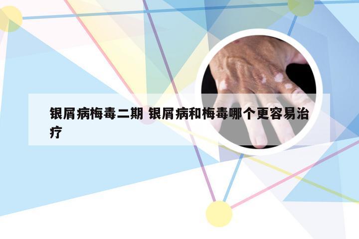 银屑病梅毒二期 银屑病和梅毒哪个更容易治疗