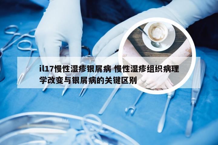 il17慢性湿疹银屑病 慢性湿疹组织病理学改变与银屑病的关键区别