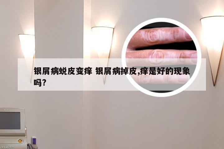 银屑病蜕皮变痒 银屑病掉皮,痒是好的现象吗?