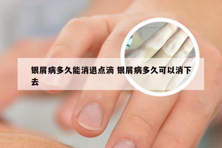 银屑病多久能消退点滴 银屑病多久可以消下去
