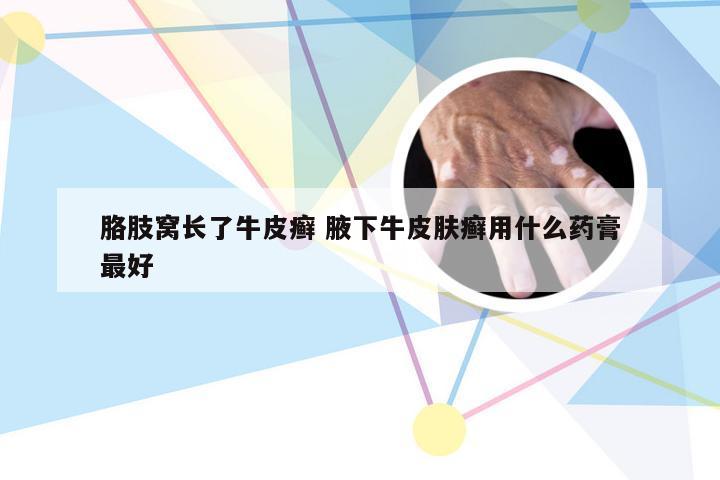 胳肢窝长了牛皮癣 腋下牛皮肤癣用什么药膏最好