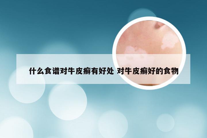 什么食谱对牛皮癣有好处 对牛皮癣好的食物