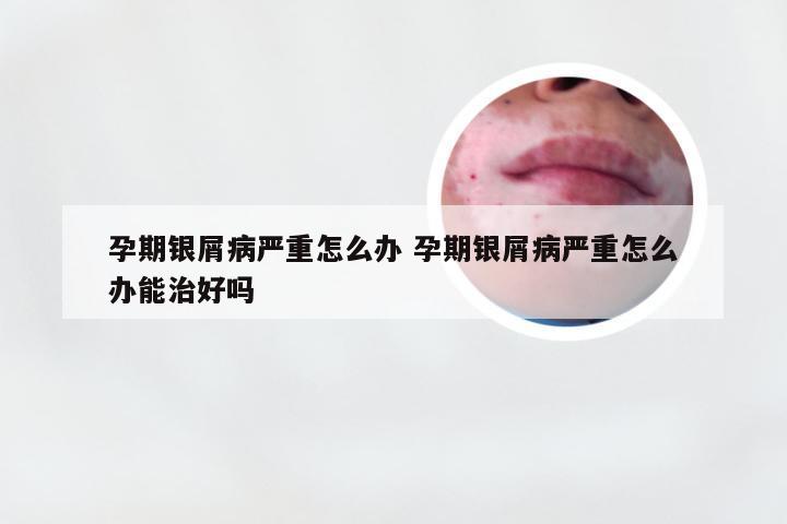 孕期银屑病严重怎么办 孕期银屑病严重怎么办能治好吗