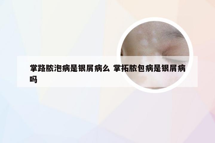 掌路脓泡病是银屑病么 掌拓脓包病是银屑病吗