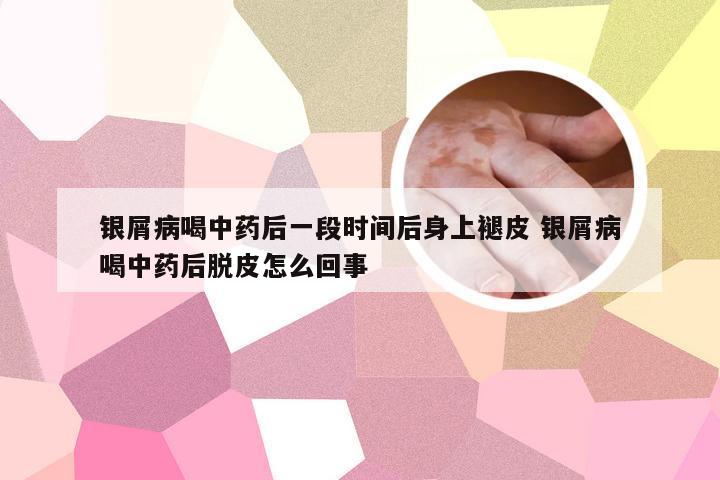银屑病喝中药后一段时间后身上褪皮 银屑病喝中药后脱皮怎么回事