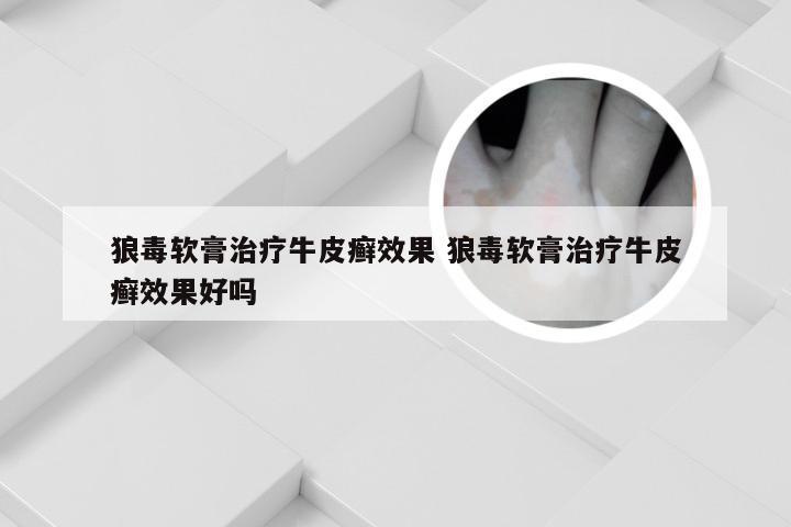 狼毒软膏治疗牛皮癣效果 狼毒软膏治疗牛皮癣效果好吗