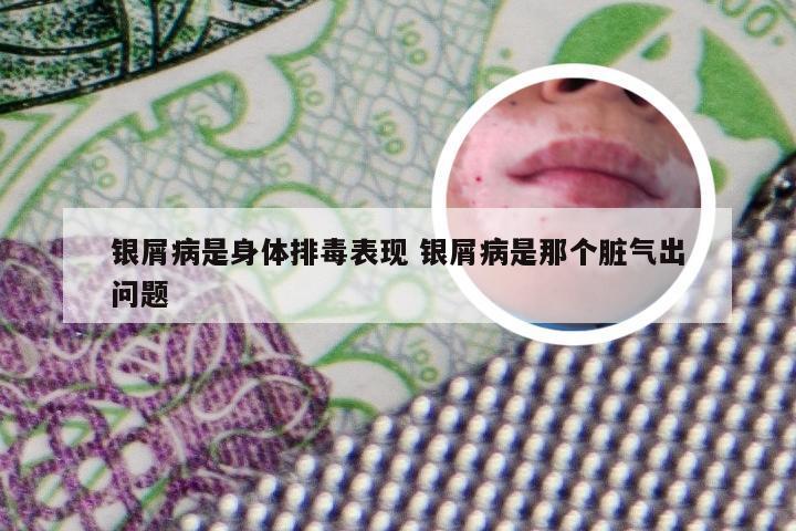 银屑病是身体排毒表现 银屑病是那个脏气出问题