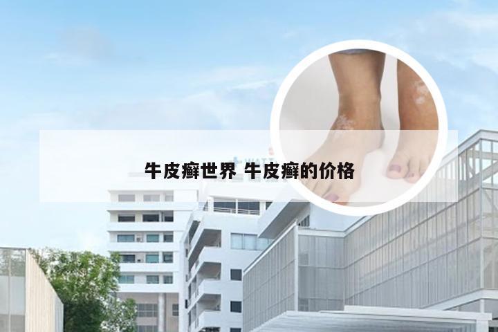 牛皮癣世界 牛皮癣的价格