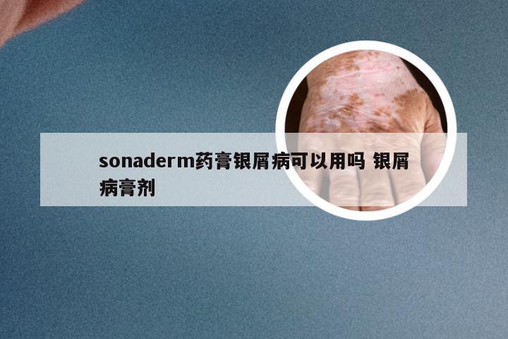 sonaderm药膏银屑病可以用吗 银屑病膏剂