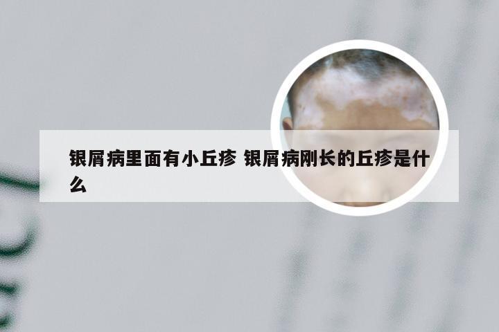 银屑病里面有小丘疹 银屑病刚长的丘疹是什么