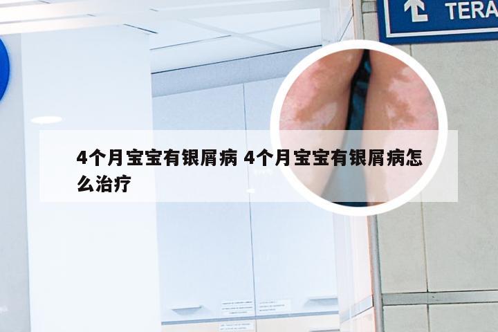 4个月宝宝有银屑病 4个月宝宝有银屑病怎么治疗