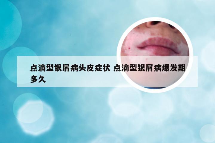 点滴型银屑病头皮症状 点滴型银屑病爆发期多久