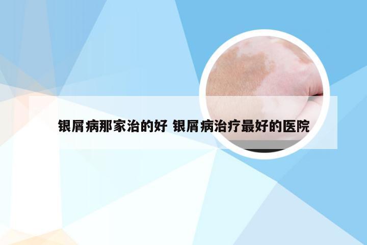 银屑病那家治的好 银屑病治疗最好的医院