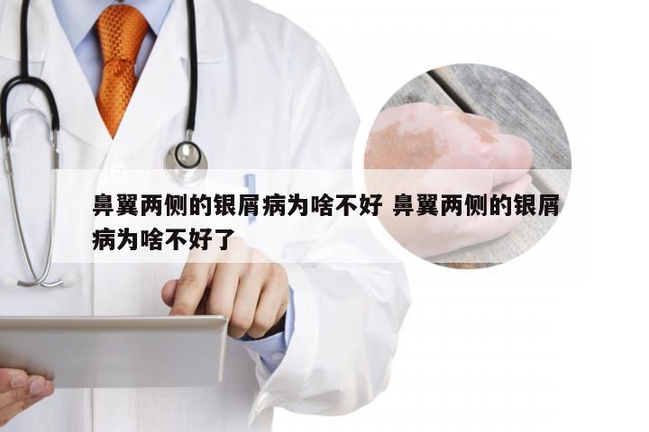 鼻翼两侧的银屑病为啥不好 鼻翼两侧的银屑病为啥不好了