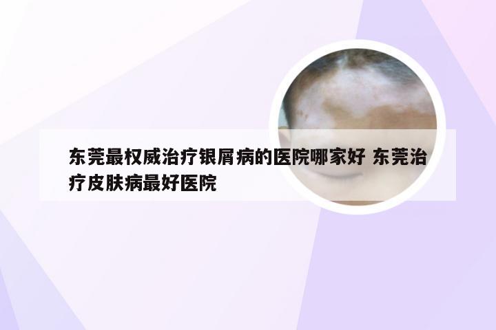 东莞最权威治疗银屑病的医院哪家好 东莞治疗皮肤病最好医院