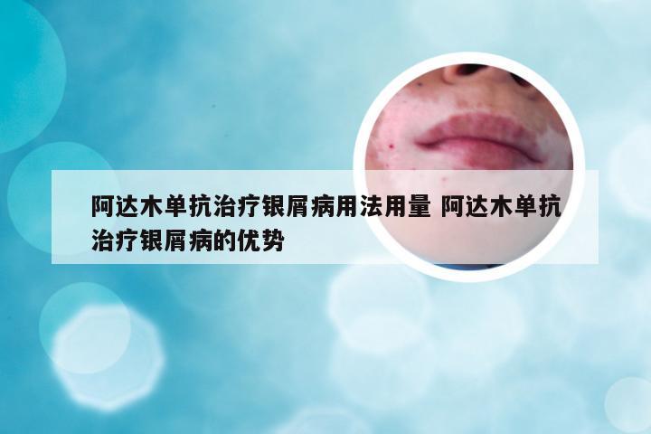 阿达木单抗治疗银屑病用法用量 阿达木单抗治疗银屑病的优势