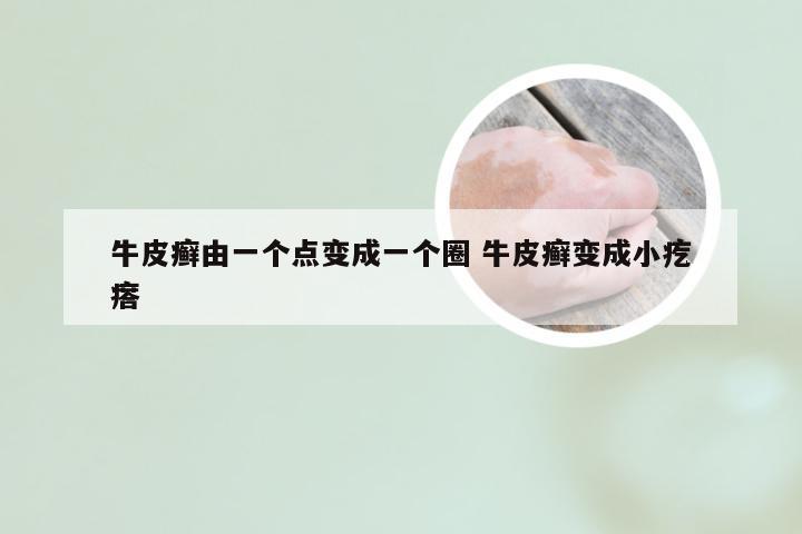 牛皮癣由一个点变成一个圈 牛皮癣变成小疙瘩