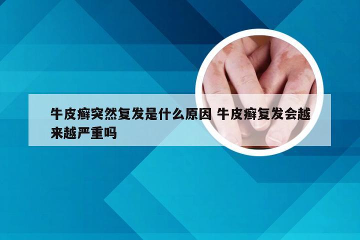 牛皮癣突然复发是什么原因 牛皮癣复发会越来越严重吗