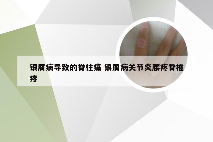 银屑病导致的脊柱痛 银屑病关节炎腰疼脊椎疼