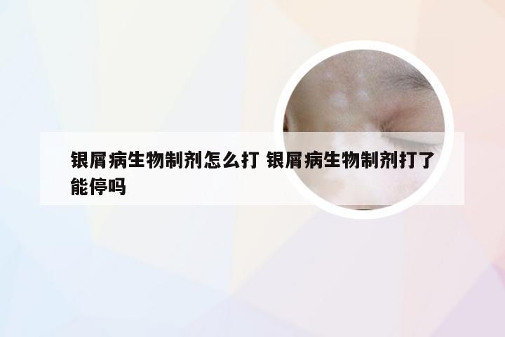 银屑病生物制剂怎么打 银屑病生物制剂打了能停吗