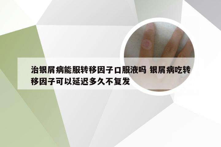治银屑病能服转移因子口服液吗 银屑病吃转移因子可以延迟多久不复发