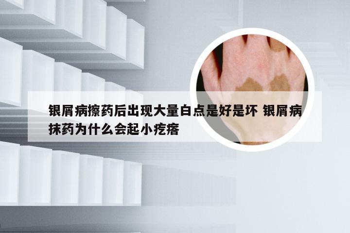 银屑病擦药后出现大量白点是好是坏 银屑病抹药为什么会起小疙瘩