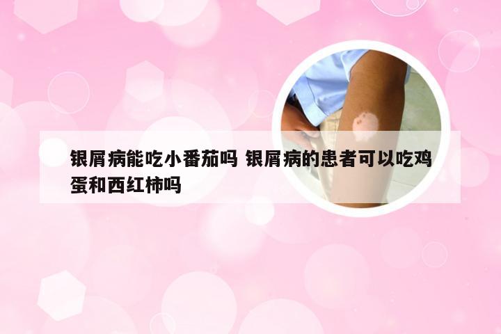 银屑病能吃小番茄吗 银屑病的患者可以吃鸡蛋和西红柿吗