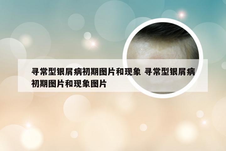 寻常型银屑病初期图片和现象 寻常型银屑病初期图片和现象图片