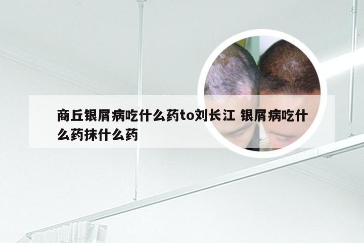 商丘银屑病吃什么药to刘长江 银屑病吃什么药抹什么药