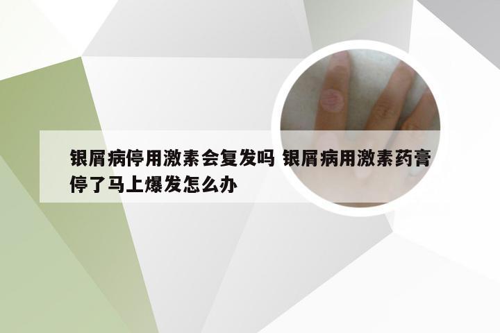 银屑病停用激素会复发吗 银屑病用激素药膏停了马上爆发怎么办