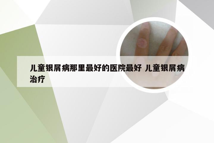 儿童银屑病那里最好的医院最好 儿童银屑病治疗