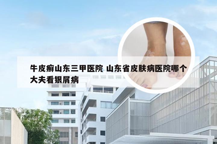 牛皮癣山东三甲医院 山东省皮肤病医院哪个大夫看银屑病