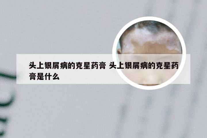 头上银屑病的克星药膏 头上银屑病的克星药膏是什么