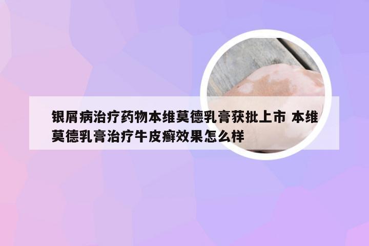 银屑病治疗药物本维莫德乳膏获批上市 本维莫德乳膏治疗牛皮癣效果怎么样